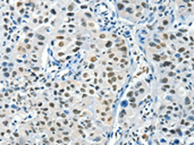 The image on the left is immunohistochemistry of paraffin-embedded Human lung cancer tissue using BCAS2 Antibody(BCAS2 Antibody) at dilution 1/50, on the right is treated with fusion protein. (Original magnification: ×200)