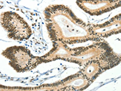 The image on the left is immunohistochemistry of paraffin-embedded Human colon cancer tissue using the antibody Antibody) at dilution 1/50, on the right is treated with fusion protein. (Original magnification: ×200)