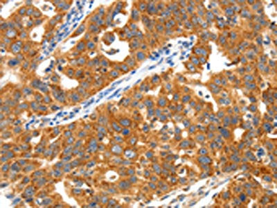 The image on the left is immunohistochemistry of paraffin-embedded Human ovarian cancer tissue using the antibody Antibody) at dilution 1/40, on the right is treated with synthetic peptide. (Original magnification: ×200)Rabbit anti-Human TRAF3 Polyclonal Antibody