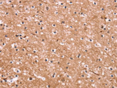 The image on the left is immunohistochemistry of paraffin-embedded Human brain  tissue using CSNK1D Antibody(CSNK1D Antibody) at dilution 1/50, on the right is treated with fusion protein. (Original magnification: ×200)Rabbit anti-Human CSNK1D Polyclonal Antibody