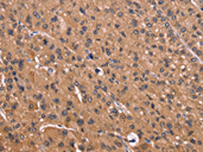 The image on the left is immunohistochemistry of paraffin-embedded Human liver cancer tissue using the antibody Antibody) at dilution 1/50, on the right is treated with fusion protein. (Original magnification: ×200)Rabbit anti-Human CSNK1D Polyclonal Antibody