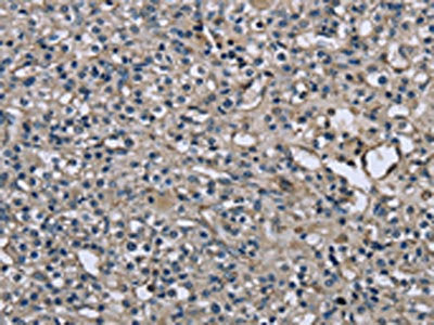 The image on the left is immunohistochemistry of paraffin-embedded Human prostate cancer tissue using MYL12B Antibody(MYL12B Antibody) at dilution 1/25, on the right is treated with fusion protein. (Original magnification: ×200)Rabbit anti-Human MYL12B Polyclonal Antibody