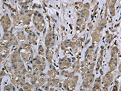 The image on the left is immunohistochemistry of paraffin-embedded Human breast cancer tissue using the antibody Antibody) at dilution 1/25, on the right is treated with fusion protein. (Original magnification: ×200)Rabbit anti-Human MYL12B Polyclonal Antibody