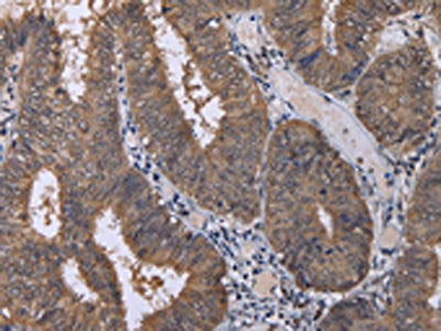The image on the left is immunohistochemistry of paraffin-embedded Human colon cancer tissue using CUL3 Antibody(CUL3 Antibody) at dilution 1/30, on the right is treated with fusion protein. (Original magnification: ×200)Rabbit anti-Human CUL3 Polyclonal Antibody