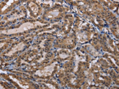 The image on the left is immunohistochemistry of paraffin-embedded Human thyroid cancer tissue using the antibody Antibody) at dilution 1/30, on the right is treated with fusion protein. (Original magnification: ×200)Rabbit anti-Human CUL3 Polyclonal Antibody