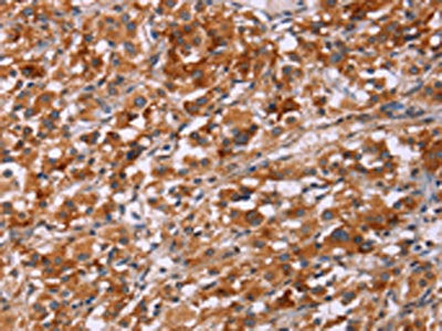 The image on the left is immunohistochemistry of paraffin-embedded Human thyroid cancer tissue using ICAM3 Antibody(ICAM3 Antibody) at dilution 1/20, on the right is treated with synthetic peptide. (Original magnification: ×200)Rabbit anti-Human ICAM3 Polyclonal Antibody