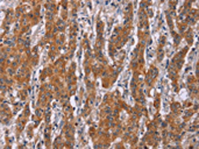 The image on the left is immunohistochemistry of paraffin-embedded Human gastic cancer tissue using the antibody Antibody) at dilution 1/20, on the right is treated with synthetic peptide. (Original magnification: ×200)Rabbit anti-Human ICAM3 Polyclonal Antibody