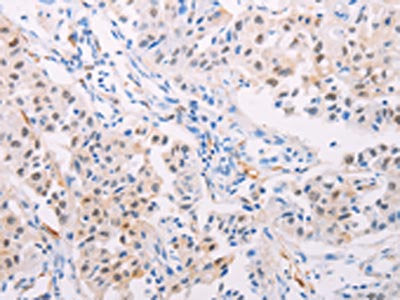The image on the left is immunohistochemistry of paraffin-embedded Human lung cancer tissue using TGM2 Antibody(TGM2 Antibody) at dilution 1/15, on the right is treated with fusion protein. (Original magnification: ×200)Rabbit anti-Human TGM2 Polyclonal Antibody