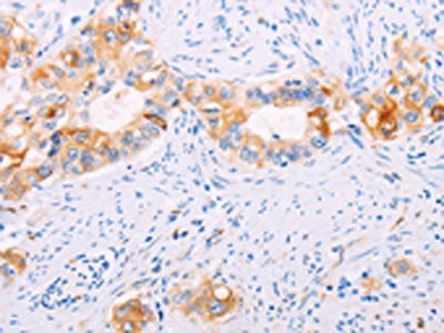 The image on the left is immunohistochemistry of paraffin-embedded Human cervical cancer tissue using the antibody Antibody) at dilution 1/15, on the right is treated with fusion protein. (Original magnification: ×200)Rabbit anti-Human TGM2 Polyclonal Antibody