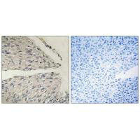 Immunohistochemistry analysis of paraffin-embedded human cervix carcinoma tissue using CIDEB antibody.Rabbit anti-Human CIDEB Polyclonal Antibody