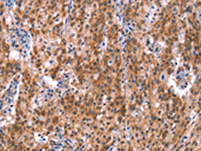 The image on the left is immunohistochemistry of paraffin-embedded Human gastric cancer tissue using GH1 Antibody(GH1 Antibody) at dilution 1/40, on the right is treated with synthetic peptide. (Original magnification: ×200)Rabbit anti-Human GH1 Polyclonal Antibody