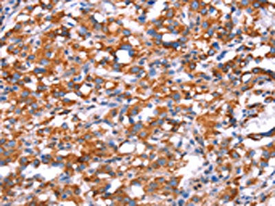 The image on the left is immunohistochemistry of paraffin-embedded Human thyroid cancer tissue using the antibody Antibody) at dilution 1/40, on the right is treated with synthetic peptide. (Original magnification: ×200)Rabbit anti-Human GH1 Polyclonal Antibody