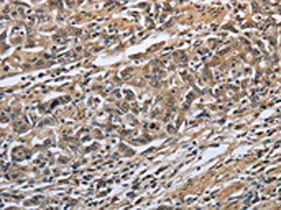 The image on the left is immunohistochemistry of paraffin-embedded Human gastric cancer tissue using PRDX6 Antibody(PRDX6 Antibody) at dilution 1/25, on the right is treated with fusion protein. (Original magnification: ×200)Rabbit anti-Human PRDX6 Polyclonal Antibody