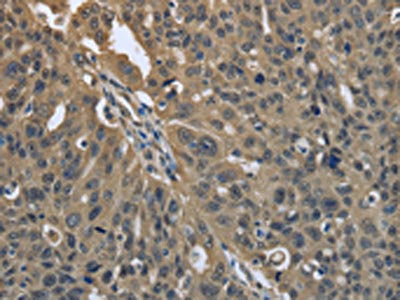 The image on the left is immunohistochemistry of paraffin-embedded Human ovarian cancer tissue using the antibody Antibody) at dilution 1/25, on the right is treated with fusion protein. (Original magnification: ×200)Rabbit anti-Human PRDX6 Polyclonal Antibody
