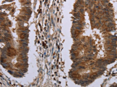 The image on the left is immunohistochemistry of paraffin-embedded Human colon cancer tissue using the antibody   Antibody) at dilution 1/20, on the right is treated with synthetic peptide. (Original magnification: ×200)