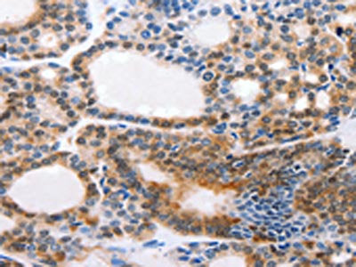 The image on the left is immunohistochemistry of paraffin-embedded Human thyroid cancer tissue using CMTM3 Antibody(CMTM3 Antibody) at dilution 1/20, on the right is treated with synthetic peptide. (Original magnification: ×200)Rabbit anti-Human CMTM3 Polyclonal Antibody