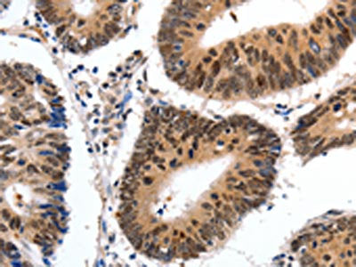 The image on the left is immunohistochemistry of paraffin-embedded Human colon cancer tissue using the antibody Antibody) at dilution 1/20, on the right is treated with synthetic peptide. (Original magnification: ×200)Rabbit anti-Human CMTM3 Polyclonal Antibody