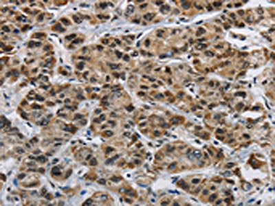 The image on the left is immunohistochemistry of paraffin-embedded Human liver cancer tissue using HNRNPL Antibody(HNRNPL Antibody) at dilution 1/40, on the right is treated with synthetic peptide. (Original magnification: ×200)Rabbit anti-Human HNRNPL Polyclonal Antibody
