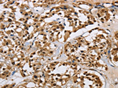 The image on the left is immunohistochemistry of paraffin-embedded Human thyroid cancer tissue using the antibody Antibody) at dilution 1/40, on the right is treated with synthetic peptide. (Original magnification: ×200)Rabbit anti-Human HNRNPL Polyclonal Antibody