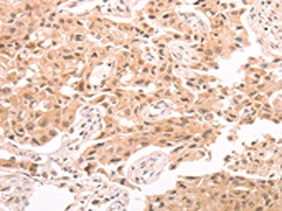 The image on the left is immunohistochemistry of paraffin-embedded Human lung cancer tissue using TRPC3 Antibody(TRPC3 Antibody) at dilution 1/80, on the right is treated with synthetic peptide. (Original magnification: ×200)Rabbit anti-Human TRPC3 Polyclonal Antibody
