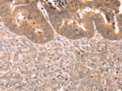 The image on the left is immunohistochemistry of paraffin-embedded Human ovarian cancer tissue using the antibody Antibody) at dilution 1/80, on the right is treated with synthetic peptide. (Original magnification: ×200)Rabbit anti-Human TRPC3 Polyclonal Antibody