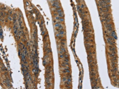 The image on the left is immunohistochemistry of paraffin-embedded Human colon cancer tissue using CAST Antibody(CAST Antibody) at dilution 1/70, on the right is treated with fusion protein. (Original magnification: ×200)