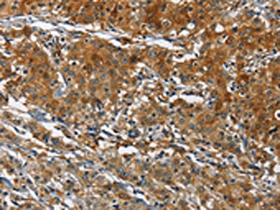 The image on the left is immunohistochemistry of paraffin-embedded Human gastic cancer tissue using the antibody Antibody) at dilution 1/70, on the right is treated with fusion protein. (Original magnification: ×200)