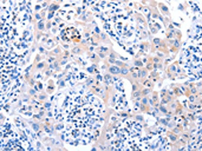 The image on the left is immunohistochemistry of paraffin-embedded Human lung cancer tissue using ACAD11 Antibody(ACAD11 Antibody) at dilution 1/15, on the right is treated with fusion protein. (Original magnification: ×200)