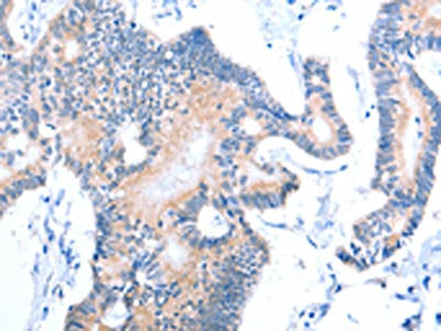 The image on the left is immunohistochemistry of paraffin-embedded Human colon cancer tissue using the antibody Antibody) at dilution 1/15, on the right is treated with fusion protein. (Original magnification: ×200)