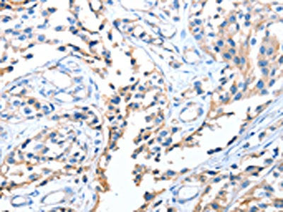 The image on the left is immunohistochemistry of paraffin-embedded Human esophagus cancer tissue using AOX1 Antibody(AOX1 Antibody) at dilution 1/65, on the right is treated with fusion protein. (Original magnification: ×200)Rabbit anti-Human AOX1 Polyclonal Antibody