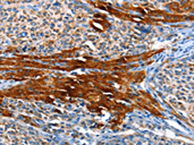 The image on the left is immunohistochemistry of paraffin-embedded Human liver cancer tissue using the antibody Antibody) at dilution 1/65, on the right is treated with fusion protein. (Original magnification: ×200)Rabbit anti-Human AOX1 Polyclonal Antibody