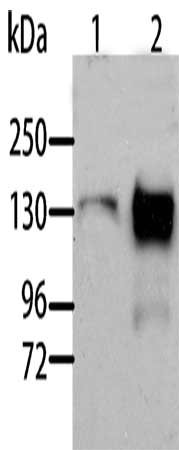 Gel: 10%SDS-PAGE, Lysate: 40 μg, Lane 1-2: Human liver cancer tissue, Human normal liver tissue, Primary antibody: AOX1 Antibody(AOX1 Antibody) at dilution 1/1000, Secondary antibody: Goat anti rabbit IgG at 1/8000 dilution, Exposure time: 90 secondsRabbit anti-Human AOX1 Polyclonal Antibody