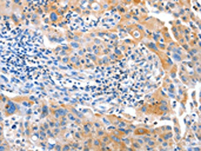 The image on the left is immunohistochemistry of paraffin-embedded Human breast cancer tissue using IMMT Antibody(IMMT Antibody) at dilution 1/12, on the right is treated with fusion protein. (Original magnification: ×200)Rabbit anti-Human IMMT Polyclonal Antibody