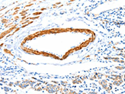 The image on the left is immunohistochemistry of paraffin-embedded Human colon cancer tissue using the antibody Antibody) at dilution 1/12, on the right is treated with fusion protein. (Original magnification: ×200)Rabbit anti-Human IMMT Polyclonal Antibody