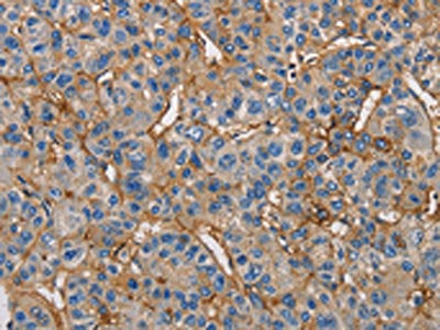 The image on the left is immunohistochemistry of paraffin-embedded Human liver cancer tissue using ICAM1 Antibody(ICAM1 Antibody) at dilution 1/50, on the right is treated with fusion protein. (Original magnification: ×200)Rabbit anti-Human ICAM1 Polyclonal Antibody