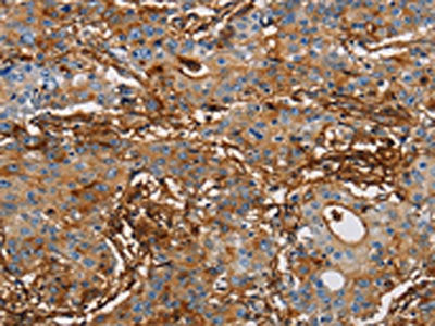 The image on the left is immunohistochemistry of paraffin-embedded Human gastic cancer tissue using the antibody Antibody) at dilution 1/50, on the right is treated with fusion protein. (Original magnification: ×200)Rabbit anti-Human ICAM1 Polyclonal Antibody