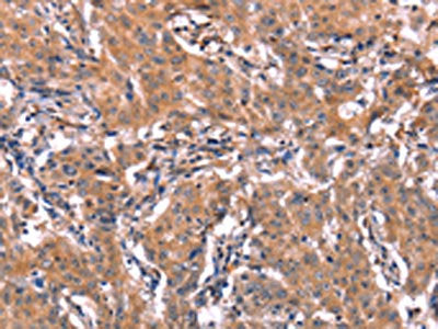 The image on the left is immunohistochemistry of paraffin-embedded Human gastric cancer tissue using ERAS Antibody(ERAS Antibody) at dilution 1/40, on the right is treated with synthetic peptide. (Original magnification: ×200)Rabbit anti-Human ERAS Polyclonal Antibody