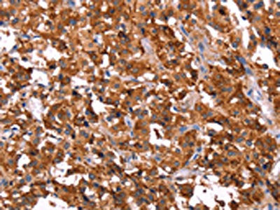 The image on the left is immunohistochemistry of paraffin-embedded Human thyroid cancer tissue using the antibody Antibody) at dilution 1/40, on the right is treated with synthetic peptide. (Original magnification: ×200)Rabbit anti-Human ERAS Polyclonal Antibody