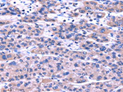 The image on the left is immunohistochemistry of paraffin-embedded Human liver cancer tissue using TRIM49 Antibody(TRIM49 Antibody) at dilution 1/40, on the right is treated with fusion protein. (Original magnification: ×200)Rabbit anti-Human TRIM49 Polyclonal Antibody