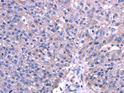 The image on the left is immunohistochemistry of paraffin-embedded Human breast cancer tissue using the antibody Antibody) at dilution 1/40, on the right is treated with fusion protein. (Original magnification: ×200)Rabbit anti-Human TRIM49 Polyclonal Antibody