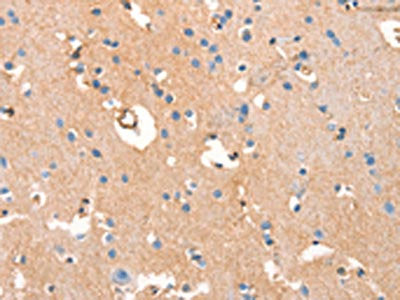The image on the left is immunohistochemistry of paraffin-embedded Human brain  tissue using ARFGEF2 Antibody(ARFGEF2 Antibody) at dilution 1/50, on the right is treated with synthetic peptide. (Original magnification: ×200)Rabbit anti-Human ARFGEF2 Polyclonal Antibody