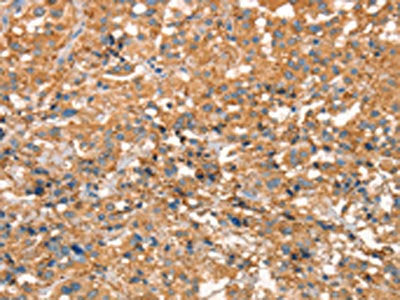 The image on the left is immunohistochemistry of paraffin-embedded Human thyroid cancer tissue using the antibody Antibody) at dilution 1/50, on the right is treated with synthetic peptide. (Original magnification: ×200)Rabbit anti-Human ARFGEF2 Polyclonal Antibody