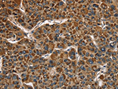 The image on the left is immunohistochemistry of paraffin-embedded Human liver cancer tissue using CAT Antibody(CAT Antibody) at dilution 1/40, on the right is treated with fusion protein. (Original magnification: ×200)