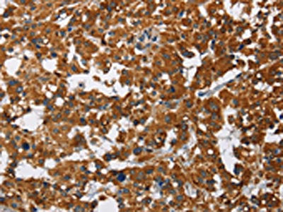 The image on the left is immunohistochemistry of paraffin-embedded Human thyroid cancer tissue using the antibody Antibody) at dilution 1/40, on the right is treated with fusion protein. (Original magnification: ×200)