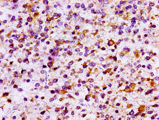 IHC image of IL10RB Antibody diluted at 1:100 and staining in paraffin-embedded human glioma performed on a Leica BondTM system. After dewaxing and hydration, antigen retrieval was mediated by high pressure in a citrate buffer (pH 6.0). Section was blocked with 10% normal goat serum 30min at RT. Then primary antibody (1% BSA) was incubated at 4°C overnight. The primary is detected by a biotinylated secondary antibody and visualized using an HRP conjugated SP system.Rabbit anti-Human IL10RB Polyclonal Antibody
