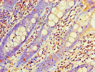Immunohistochemistry of paraffin-embedded human colon tissue using EHHADH Antibody at dilution of 1:100Rabbit anti-Human EHHADH Polyclonal Antibody
