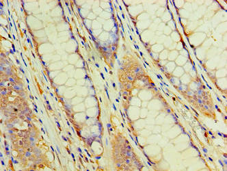 Immunohistochemistry of paraffin-embedded human colon cancer using EHHADH Antibody at dilution of 1:100Rabbit anti-Human EHHADH Polyclonal Antibody