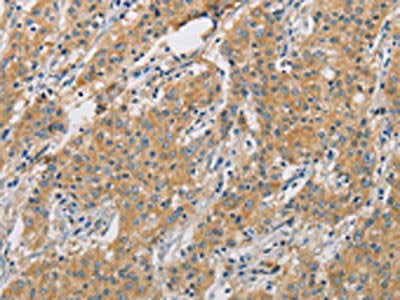 The image on the left is immunohistochemistry of paraffin-embedded Human gastric cancer tissue using ARHGEF7 Antibody(ARHGEF7 Antibody) at dilution 1/40, on the right is treated with fusion protein. (Original magnification: ×200)Rabbit anti-Human ARHGEF7 Polyclonal Antibody