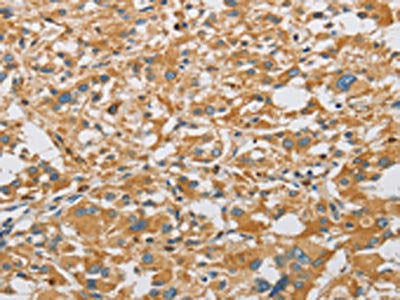 The image on the left is immunohistochemistry of paraffin-embedded Human thyroid cancer tissue using the antibody Antibody) at dilution 1/40, on the right is treated with fusion protein. (Original magnification: ×200)Rabbit anti-Human ARHGEF7 Polyclonal Antibody