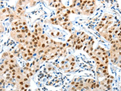 The image on the left is immunohistochemistry of paraffin-embedded Human lung cancer tissue using APPL1 Antibody(APPL1 Antibody) at dilution 1/70, on the right is treated with fusion protein. (Original magnification: ×200)Rabbit anti-Human APPL1 Polyclonal Antibody